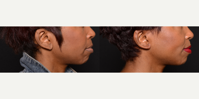 Woman treated with Earlobe Surgery - Woman treated with Earlobe Surgery