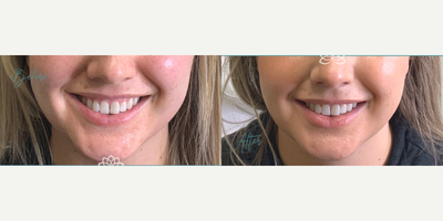 18-24 year old woman treated with Botox for Gummy Smile - Botox was used about the patient's lip for a lip flip to correct the gummy smile.