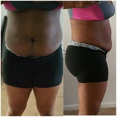Could I get a flat stomach with lipo and a mini tummy tuck ...