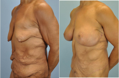 51 year old woman treated with Body Lift - After losing 180 pounds, this patient elected to have body contouring surgery including breast lift and augmentation with 500cc Mentor implants, axillary roll resection, brachioplasty (arm lift), panniculectomy, buttocks lift, and belt lipectomy.
