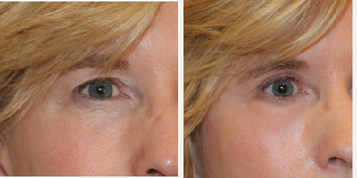 35-44 year old woman treated with CO2 Laser - This is a close-up photo showing a before and after of CO2 laser resurfacing around the eyes.