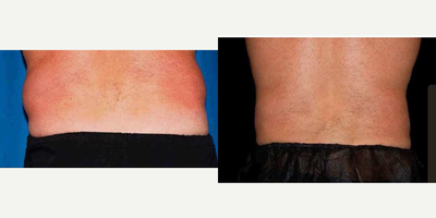 45-54 year old man treated with CoolSculpting - 57 year old Athletic patient who could not get rid of his love handles . 2 hour treatment and 3 months later with great results