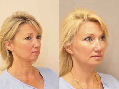 53 y.o. mother of two - Quicklift with neck, upper eyelids done in the office under oral sedation and local anesthesia