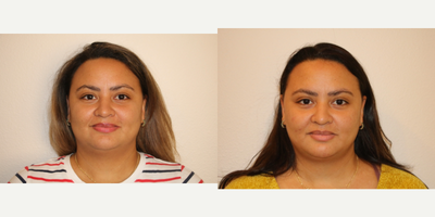 25-34 year old woman treated with Buccal Fat Removal - This patient is shown before and 3 months postoperative buccal fat removal. She also had two Kybella treatments to the submental area.