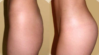 25-34 year old woman treated with Butt Implants - 25-34 year old woman treated with Butt Implants