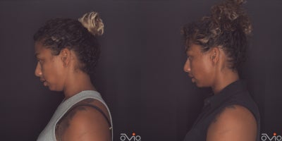 35-44 year old woman treated with MyEllevate - 7 months post MyEllevate with liposuction and RF energy