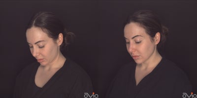 25-34 year old woman treated with MyEllevate, PrecisionTx - 25-34 year old woman treated with MyEllevate,and PrecisionTx to mid face and neck