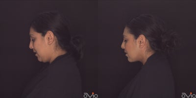 35-44 year old woman treated with MyEllevate - 6 weeks post MyEllevate with liposuction and RF energy