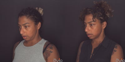 35-44 year old woman treated with MyEllevate - 35-44 year old woman treated with MyEllevate and PrecisionTX Smart Laser to mid face and neck