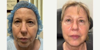 Woman treated with Ultherapy, Dermal Fillers - Look at the improvement & lifting of the upper eyelids Non-surgical laser, Ultherapy & fillers!