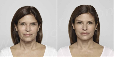Woman treated with Restylane - Restylane-L: 3.0cc to Nasolabial Folds, Marionette Lines, and Upper Lip. Dysport: 50 units to Glabella.