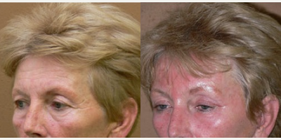 Woman treated with Eyelid Surgery - Woman treated with Eyelid Surgery