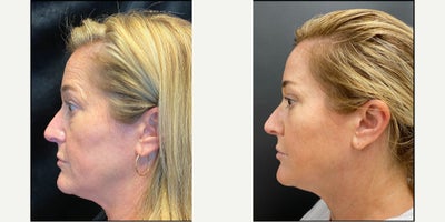 35-44 year old woman treated with Microneedling, Micro Botox - Treated at Modern Women's Health