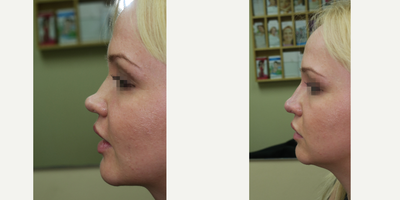 25-34 year old woman treated with Non Surgical Nose Job - young woman injected with Juvederm for non-surgical nose correction to
address depressed profile