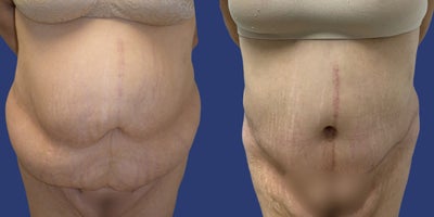 45-54 year old woman treated with Panniculectomy - The patient presented for a combined procedure including a panniculectomy with additional liposuction of the flanks, diastasis recti, and navel reconstruction. She sought to remove excess abdominal skin and improve overall abdominal contour. The accompanying photos show the patients results 5 months post-procedure.