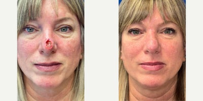 55-64 year old woman treated with Facial Reconstructive Surgery - Nasal Tip Reconstruction Using a Dorsal Nasal Flap Following Mohs Surgery for Nasal Tip Skin Cancer