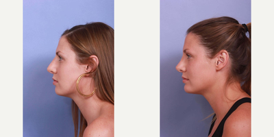 18-24 year old woman treated with Rhinoplasty - Age: 18 - 29. Woman treated with Rhinoplasty