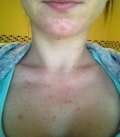 rash and pain Facial chest