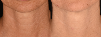 35-44 year old woman treated with Morpheus8 Microneedling RF - 35-44 year old woman treated with Morpheus8 Microneedling RF on neck.