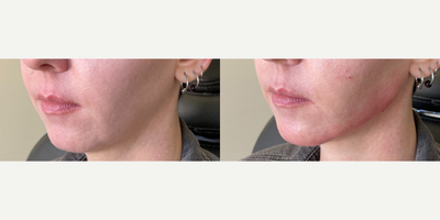 25-34 year old woman treated with Radiesse - Non Surgical Jawline and Chin Enhancement using Radiesse.