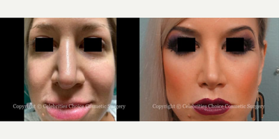 Woman treated with Revision Rhinoplasty - This patient had several unsuccessful open Rhinoplasty procedures elsewhere, and she had her third revision here which included: removing her spreader grafts, rotating the tip, and using cartilage grafting to achieve maximum tip support ( 7 months post operation).
