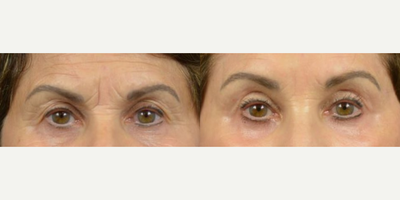 Woman treated with Eyelid Surgery, Brow Lift - Patients Area(s) of Concern: Face/Brow/Eyes.Goal: Target sagging jowls, frown lines, and excess skin of the upper eyelid.Surgeon: Dr. Marotta.Procedure(s): Blepharoplasty, Endoscopic Browlift, Facelift.Results: Patient is confident in her rejuvenated appearance and youthful results.