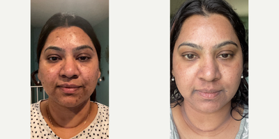 HALO FOR THE WIN - Our patient had searched for years to find a Doctor that could treat her acne scars and hyperpigmentation, safely. Very few Doctors can successfully reduce scars on darker skin tones, without causing further discoloration. We are the experts in this field and she trusts us to help her do what no one else could. We used the exceptional Halo laser at a safe setting, and curated a post-procedure aftercare regime to expedite her healing and maximize the results. Halo is the world's first laser that uses both ablative and non-ablative lasers to get the best results and reduce recovery time.Her healing was accelerated by using the Emer Skin Illuminating Mask on Day 1, Day 3 and Day 7 of her recovery journey. ADD EMER SKIN FOR THE BEST RESULTSNo treatment is complete without EMER SKIN. Using our products post-treatment will enhance results to the absolute maximum. Click Link in Bio Click Emer Skin