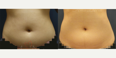 25-34 year old woman treated with SculpSure - Non-surgical removal of stubborn fat in belly and flanks with SculpSure (compare with CoolSculpting)