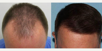 Man treated with Hair Loss Treatment - Man treated with Hair Loss Treatment
