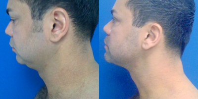 35-44 year old man treated with Smart Lipo - clear double chin improvement with laser liposuction of the chin/neck area in a thirty year old male.