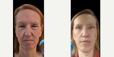 45-54 year old woman treated with Facelift, Facial Fat Transfer, Eyelid Surgery, Canthoplasty, Lip Lift, Neck Lift - Pleasant results after full facelift.