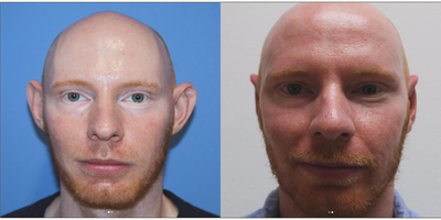 Man treated with Ear Surgery - Man treated with Ear Surgery.