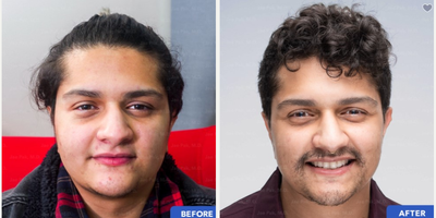 Beard Transplant F2M - 1200 grafts from FUT Strip procedure to Mustache/Goatee area