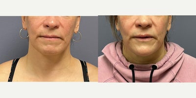 45-54 year old woman treated with Genioplasty - This young woman desired to feminize her chin by making it more round and coming to a point.