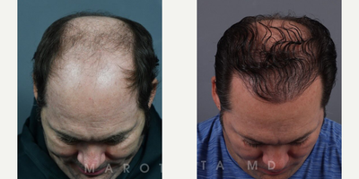Man treated with Hair Loss Treatment - Transplant Transformation.