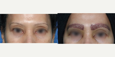 35-44 year old woman treated with Eyebrow Transplant - This lady wanted to have full eyebrow restoration.For each brow approx.:1- 220 single grafts2- 50 double grafts (placed in the central body of each brow to give a denser look)