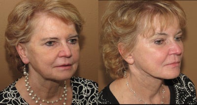 laser resurfacing -
complex facial rejuvenation including laser