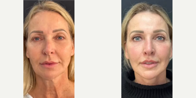 Woman treated with Neck Lift - Woman treated with Deep Plane Facelift as well as Temporal Brow Lift, Lip Lift, and Facial Fat Transfer, shown 3 months post op.