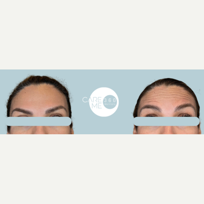 35-44 year old woman treated with Botox - When we do a botox application, we do it with a proprietary technique that allows us to give natural results without altering the facial expression. This technique is called multipoint microdosing and it involves applying small doses in multiple points and what is really important here is the form of application.
