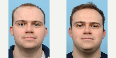 18-24 year old man treated with FUE Hair Transplant, Hair Transplant, Hair Loss Treatment, PRP for Hair Loss - This 23-year-old patient was experiencing thinning hair, specifically in the front and around the temples. Dr. Wise performed an FUE hair transplant along with a treatment of PRP to restore lost hair and thicken the existing hair. After photos were taken one year post-op.