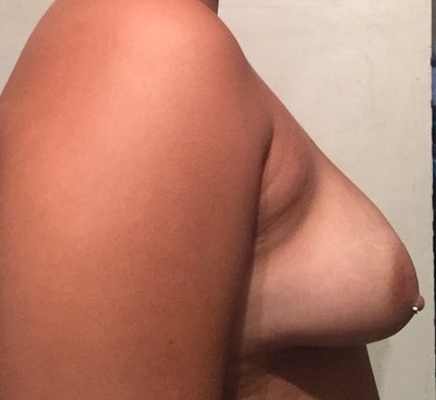 I have saggy breast