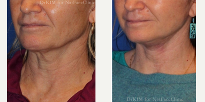 55-64 year old woman treated with Facelift, Chin Liposuction, CO2 Laser, Lip Lift - This patient had a facelift, submental liposuction, eCO2 laser to her bilateral periorbital areas and SMAS to her upper and lower lips.