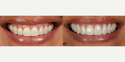 Woman treated with Porcelain Veneers - Woman treated with Smile Makeover, Porcelain Veneers