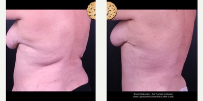 55-64 year old woman treated with Breast Reduction, Breast Fat Transfer, Vaser Liposuction - Breast Reduction + Fat Transfer to Breast, Vaser Liposuction (Lower Back) after 1 year