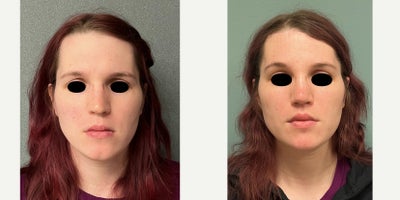 25-34 year old woman treated with Brow Bone Reduction, Forehead Reduction, Brow Lift, Rhinoplasty, Lip Lift - this is a young lady who under forehead reconstruction, septorhinoplasty, lip lift, and anterior mandible/chin feminization.