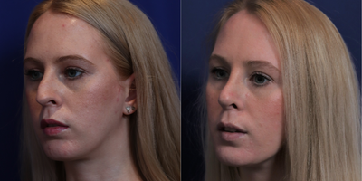 35-44 year old woman treated with Rhinoplasty - Primary rhinoplasty with ear cartilage grafts