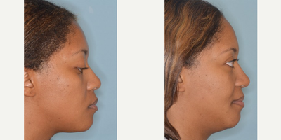 25-34 year old woman treated with African American Rhinoplasty - African American female who desired refinement to her tip. The nasal tip skin was de-fatted. Tip refinement and shape achieved with a caudal extension graft and shield graft. Tip refinement seen post-operatively. Base view demonstrates a more pyramidal tip shape. She is seen here on her 5 month post-op.