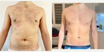 35-44 year old man treated with Vaser Liposuction - Before and after view of VASER Mid-Definition on the abdomen, highlighting the detailed sculpting achieved. This technique offers a subtle yet impactful enhancement of the abdominal contours, demonstrating the precision and effectiveness of VASER technology.