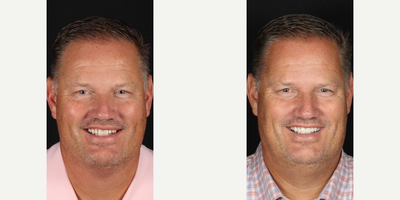 Man treated with Porcelain Veneers - Man treated with Porcelain Veneers, Smile Makeover