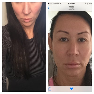 Facial Fat Transfer with BBL. Staten Island, NY - Fat ...